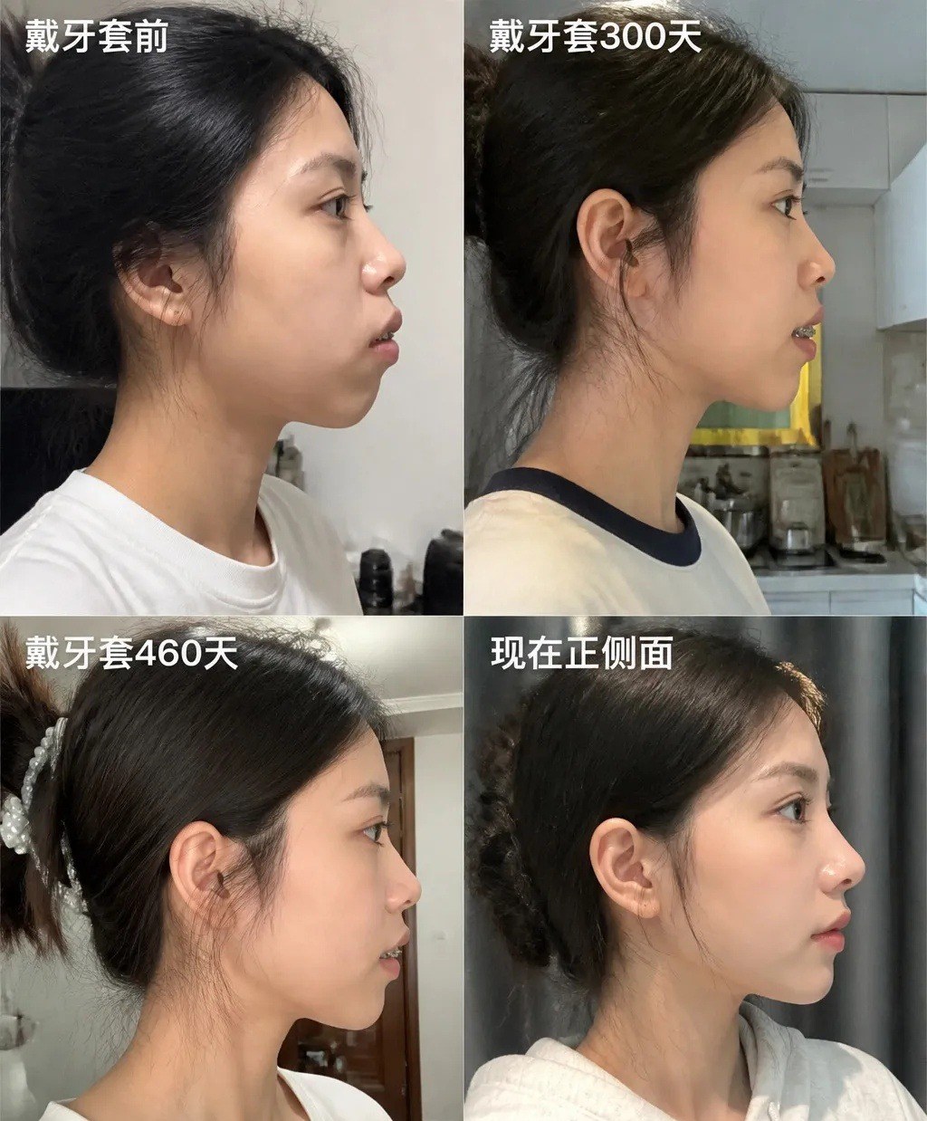 段博仕口腔牙齿矫正460天侧脸对比：戴牙套前、戴牙套300天、戴牙套460天、现在正侧面四阶段对比图